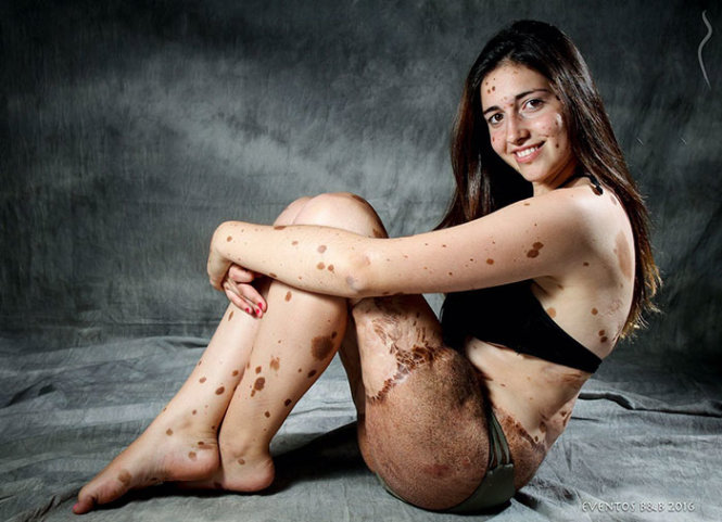 Alba Parejo không ngại cho mọi người thấy những nốt ruồi và vết chàm trên cơ thể cô