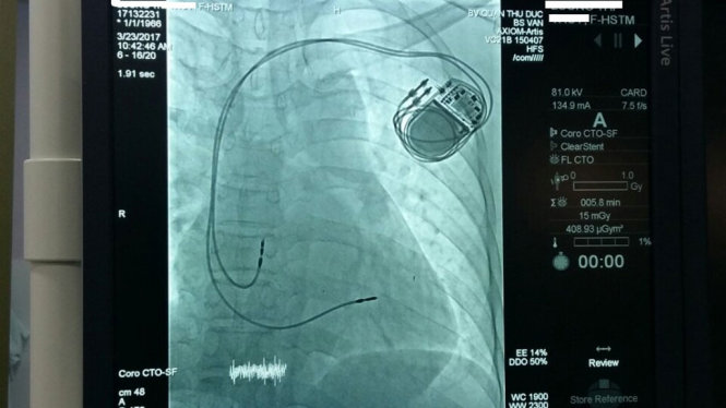 Hình ảnh xquang sau khi cấy máy tạo nhịp tim cho bà T - Ảnh: Bệnh viện cung cấp