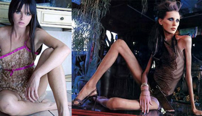 Bức ảnh ghép nổi tiếng của Carolina Reston cho thấy cô trước và khi bị chứng chán ăn - Ảnh: Pinterest