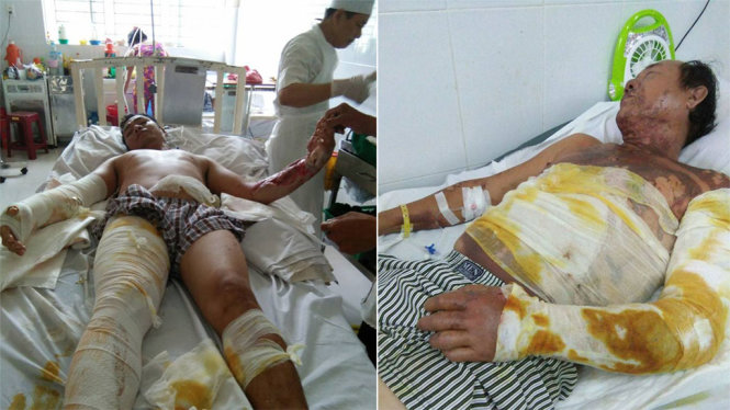 Ông Nguyễn Minh Cảnh (trái) và ông Huỳnh Văn Tiến đang điều trị tại bệnh viện Bệnh viện Chợ Rẫy