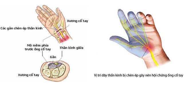 Hội chứng ống cổ tay – căn bệnh nhân viên văn phòng thường gặp ...