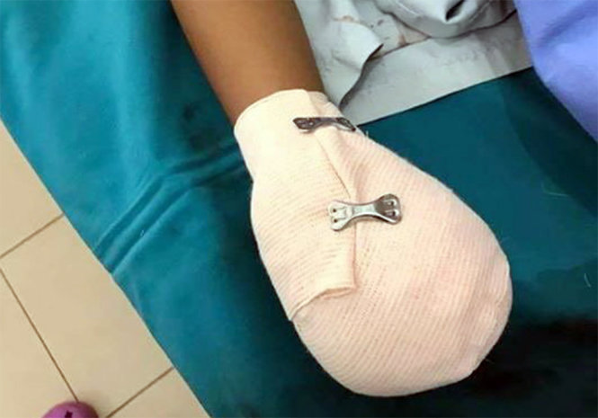 Bàn tay một bé trai bị thương vì nổ viên pin nhặt trên đường - Ảnh: BVCC