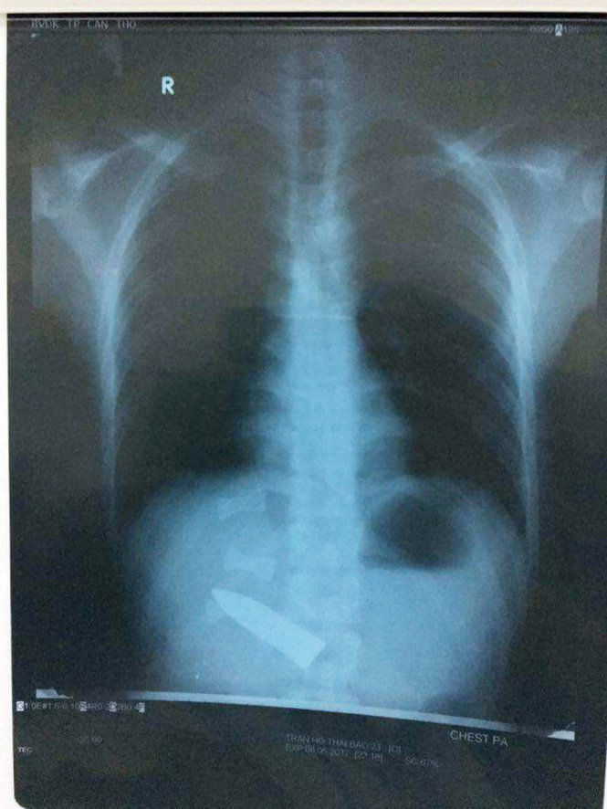 Hình ảnh X quang lưỡi dao xuyên phía sau lưng