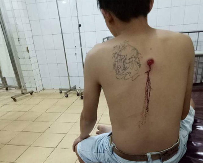 Vết thương trên vùng lưng của anh Bùi Văn Lượng do bị đạn cao su găm trúng - Ảnh: Người dân cung cấp.