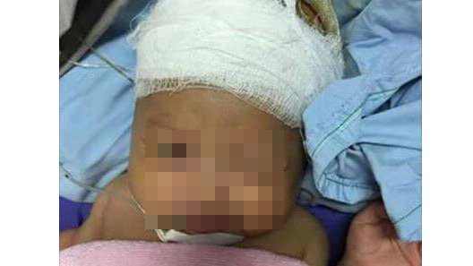 Em bé 37 ngày được ghép sọ ở Quảng ninh - Ảnh: bệnh viện cung cấp