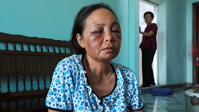 Sau hai ngày xảy ra vụ việc tinh thần của bà Nguyễn Thị Phúc vẫn còn hoảng loạn, trên mặt nhiều vết bầm tím do bị đánh - Ảnh: Giang Long