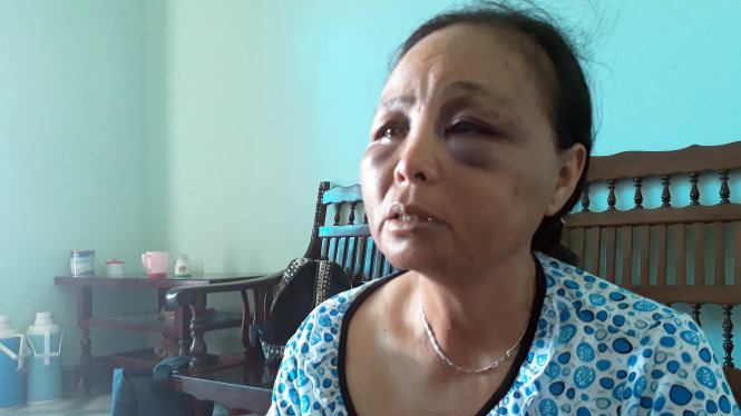 Bà Nguyễn Thị Phúc, một trong hai phụ nữ bán tăm, bị người dân vây đánh đến bầm tím mặt - Ảnh: GIANG LONG
