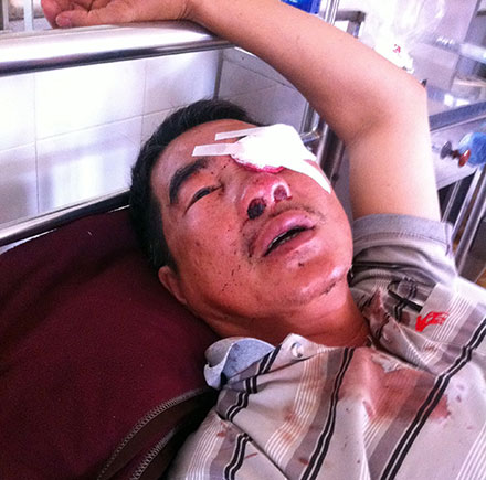 Ông Trương Triệu Lương bị ném đá gây hư mắt trái đang điều trị  tại Bệnh viên Đa khoa tỉnh Đắk Lắk - Ảnh: Trung Tân