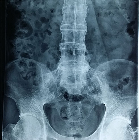 Hình ảnh chụp khớp cùng chậu của một bệnh nhân - Ảnh: N.A.