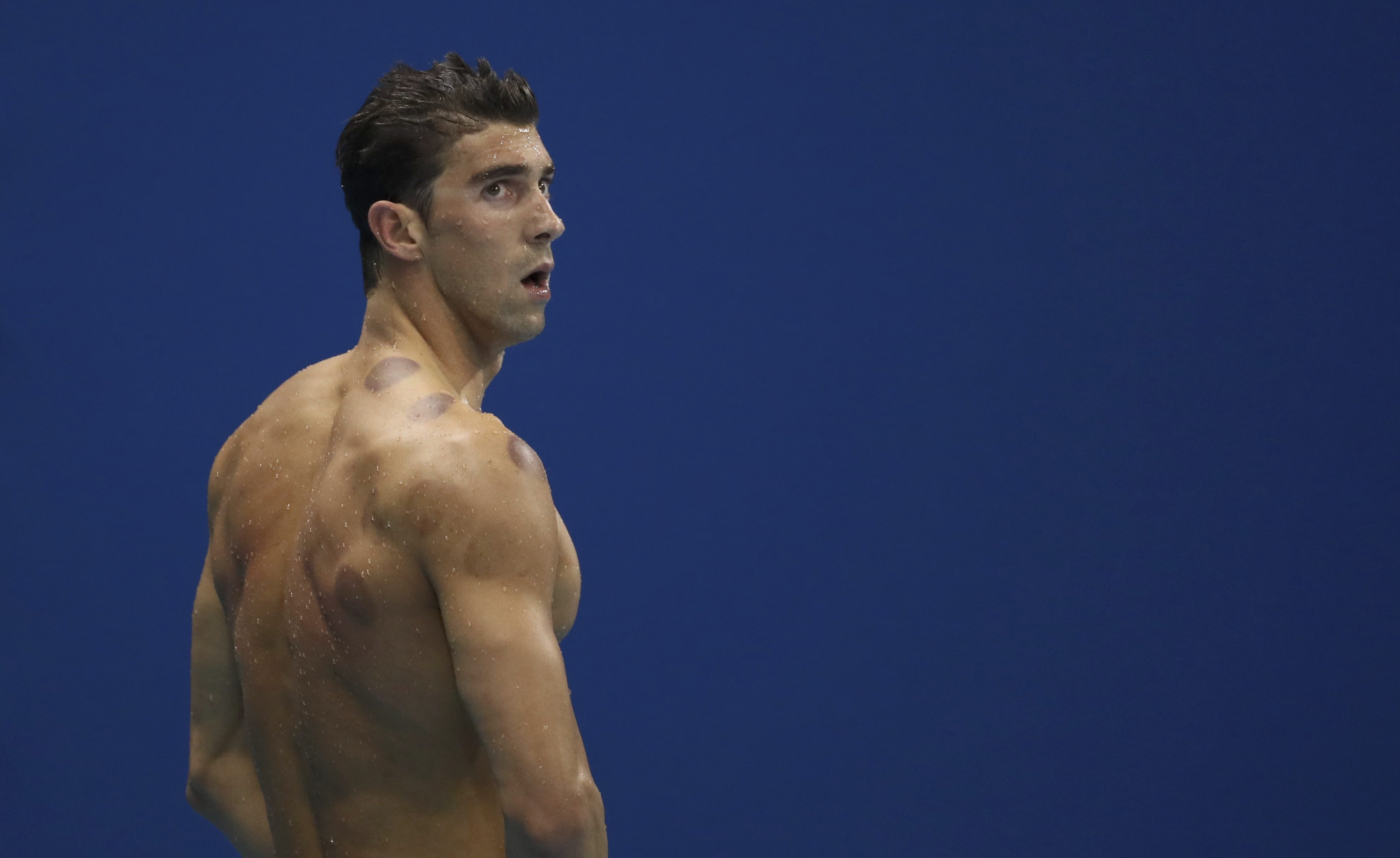 Phelps với những “dấu tích” giác hơi trên cơ thể Ảnh: Reuters
