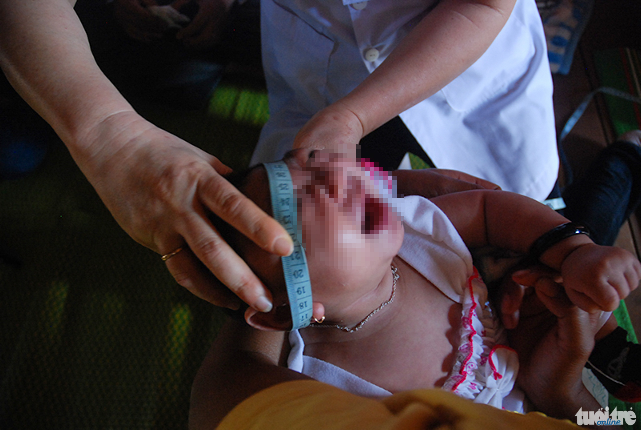 Các y bác sĩ thăm khám, kiểm tra vòng đầu cho bé dị tật đầu nhỏ nghi do vi rút Zika tại huyện Krông Búk, tỉnh Đắk Lắk - Ảnh: Thái Bá Dũng